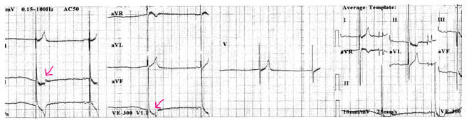 ekg